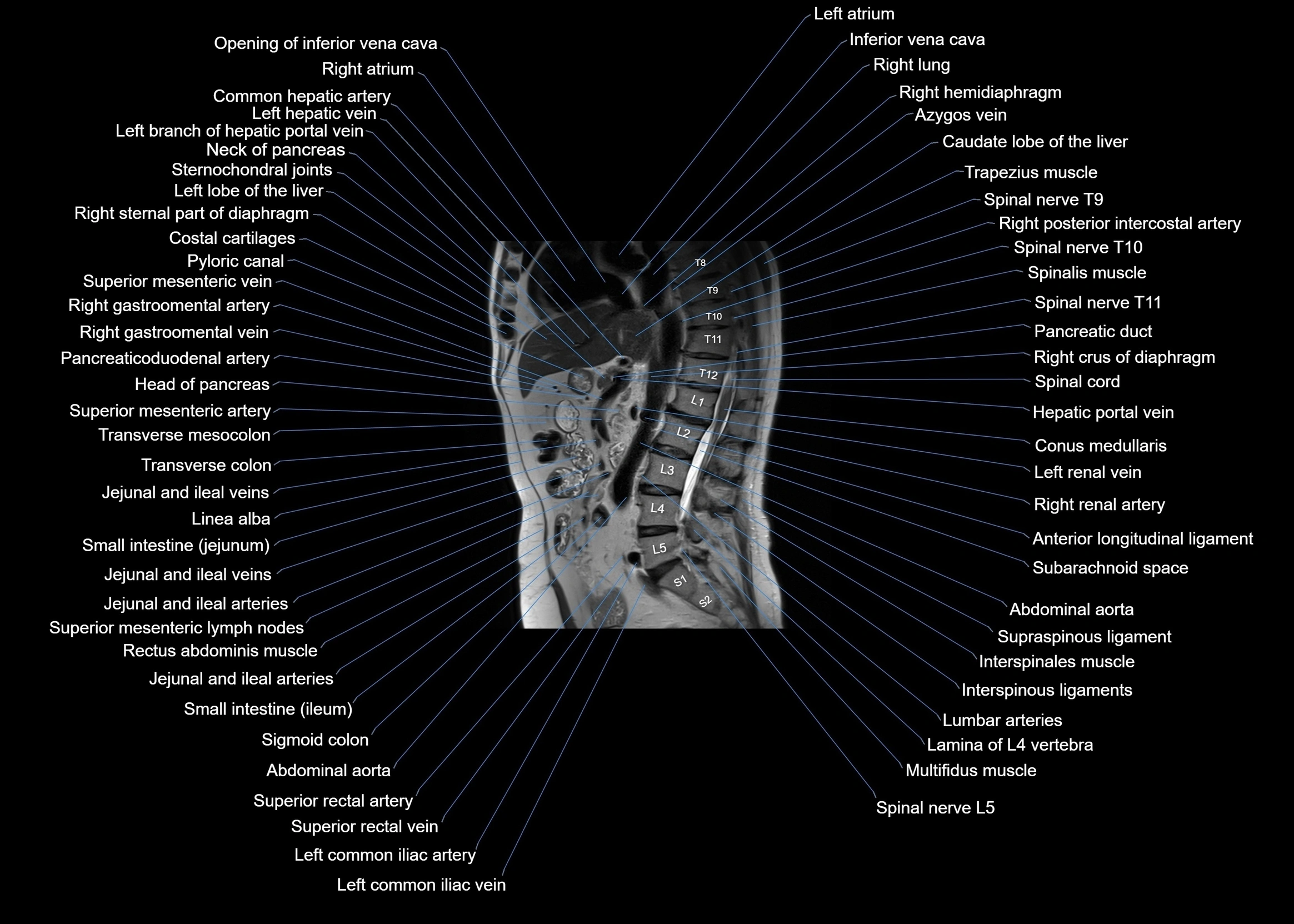 MRI abdomen sagittal cross sectional anatomy  radiology  image-img-00001-00037.webp